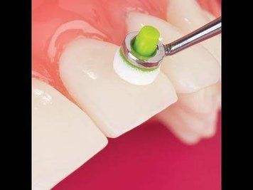 Ivoclar, OptraSculpt (тримач+120 насадок), інструмент моделювальний інноваційний 4610-2001 фото