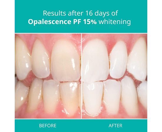 Гель для відбілювання зубів Opalescence 10% Ultradent шприц 1.2мл 3010-2746 фото